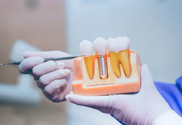 OdontocarePremium - Imagem Serviço de Implantes Dentários