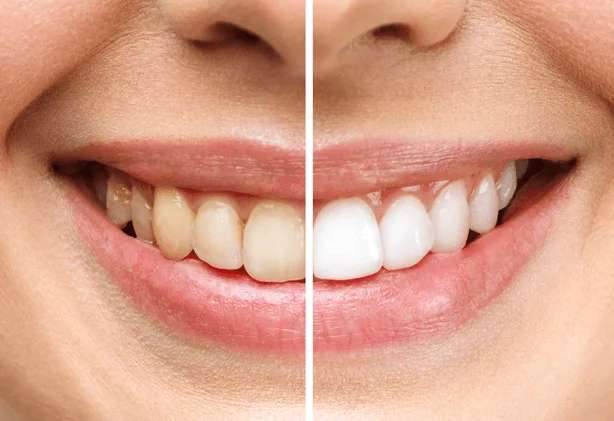 OdontocarePremium - Imagens Facetas Dentárias